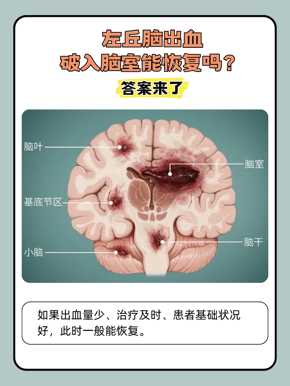 脑出血恢复期最长要多久