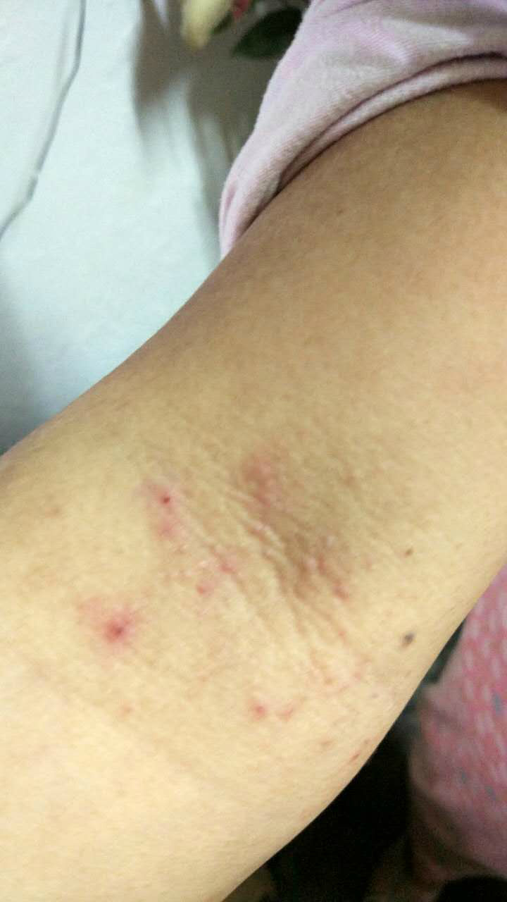 一热身上就痒痒,受不了,像针扎