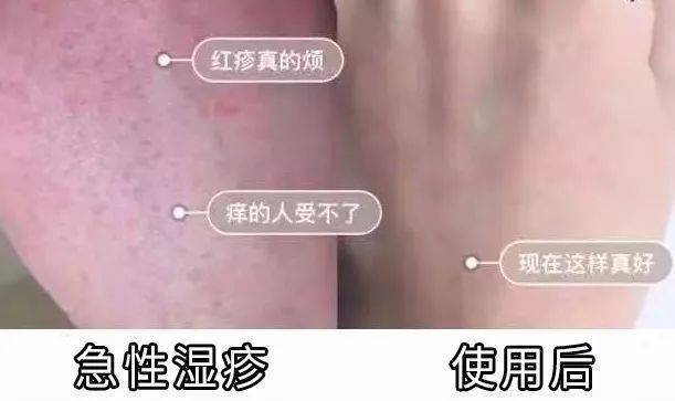 外阴湿疹的症状及治疗方法