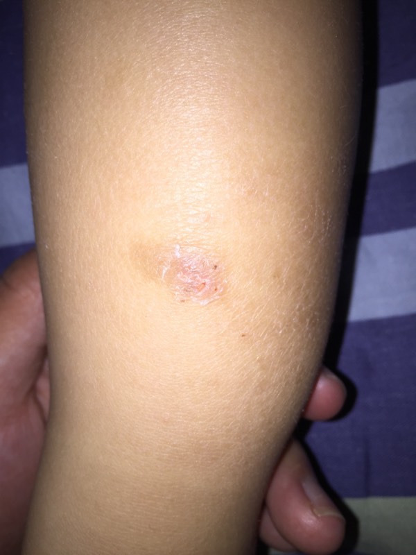 寻常型牛皮癣的初期图片症状是怎样的