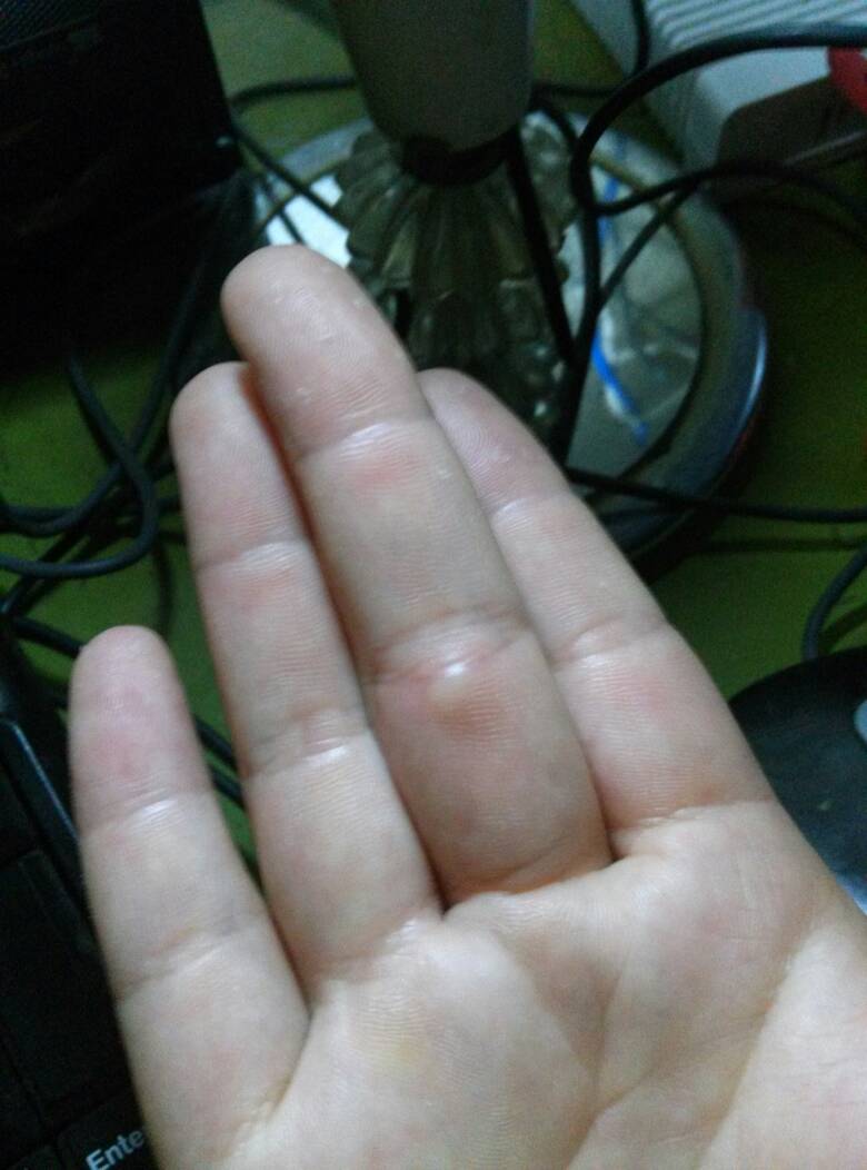手上长了个疙瘩,不痛不痒