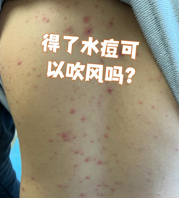 为什么出水痘不能吹风?