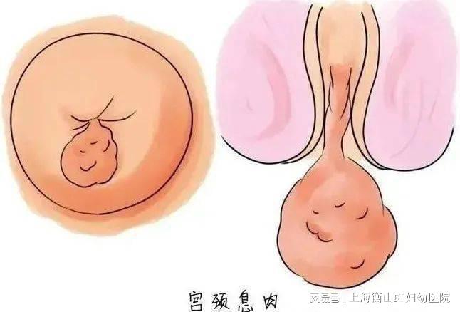 子宫颈息肉是什么?