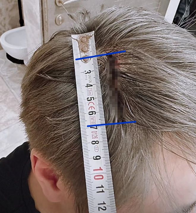 5厘米头发一周最快长几厘米