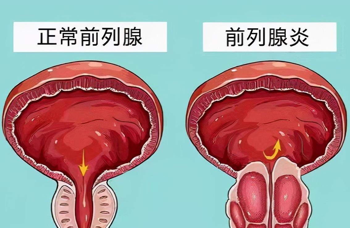 前列腺炎是怎么回事