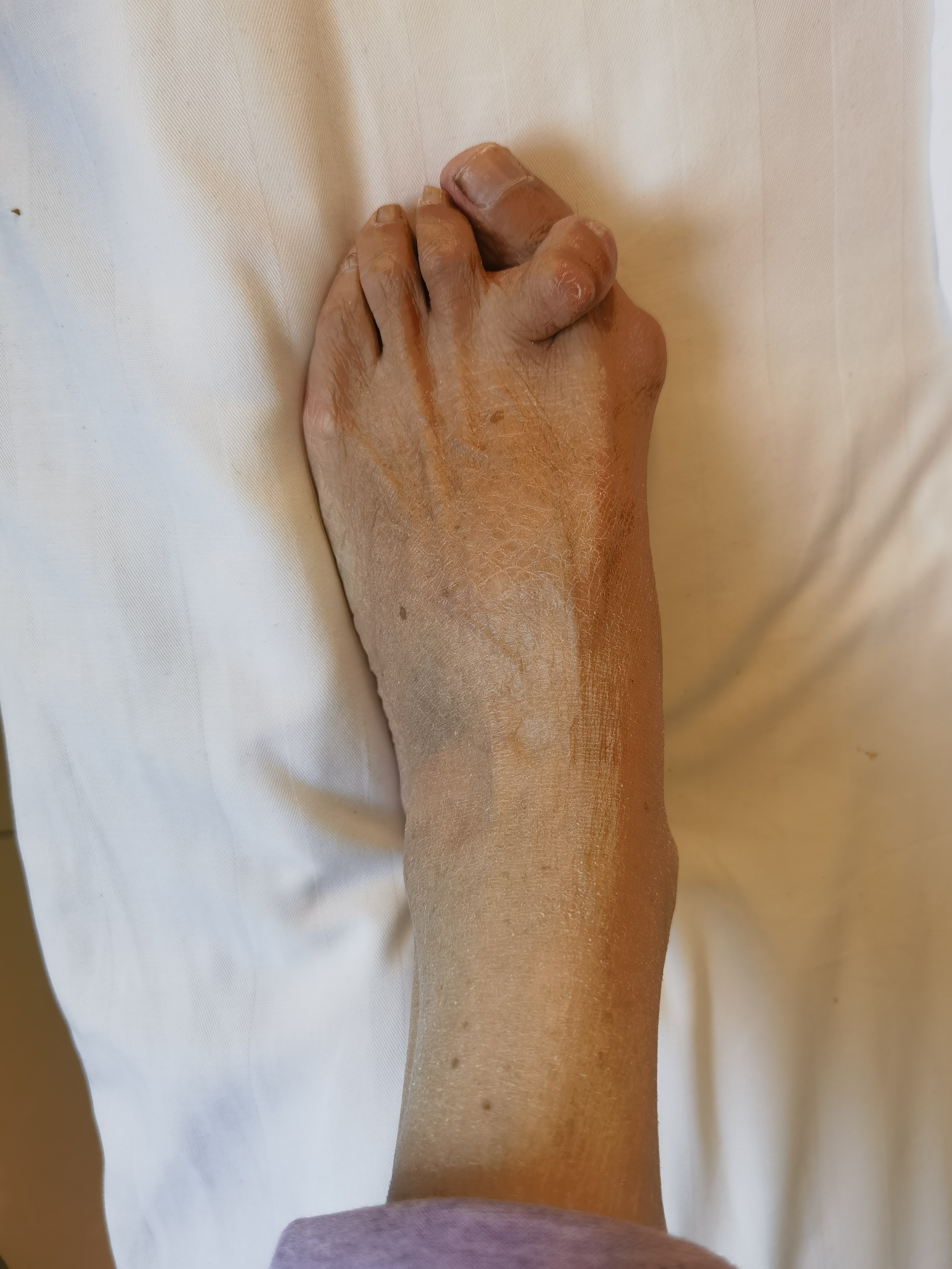 脚趾头痛是怎么回事