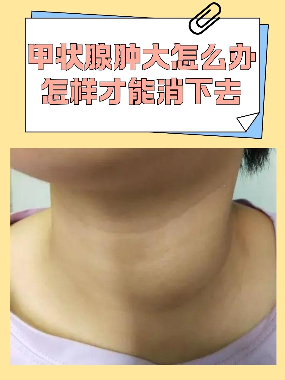 三碘甲状腺原氨酸偏高导致什么后果