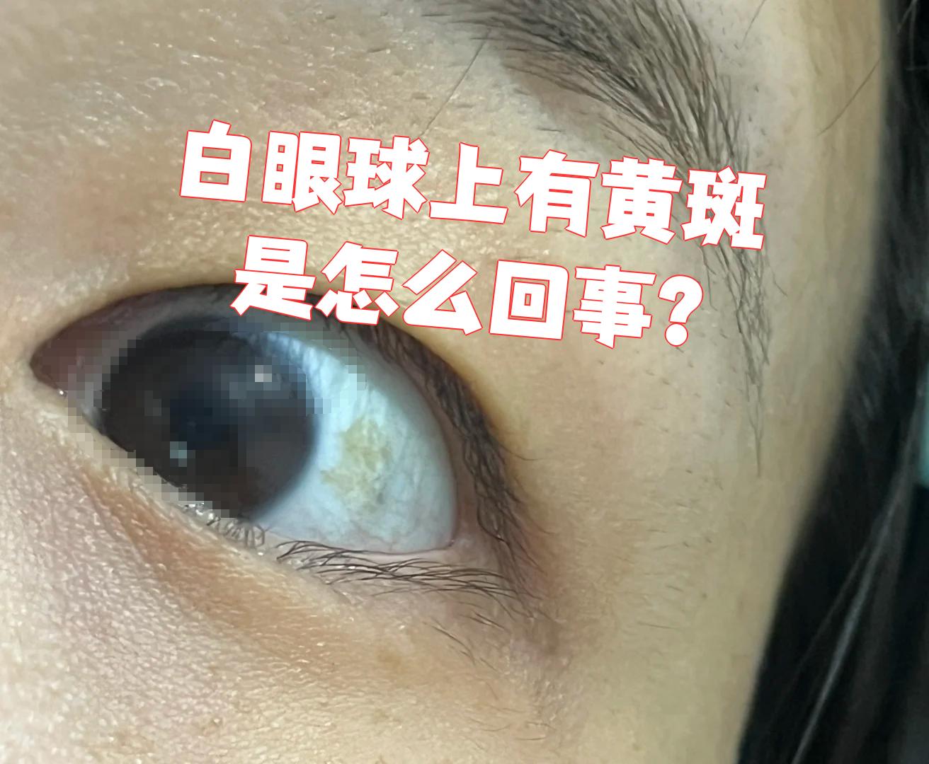 白眼球有黑点怎么回事