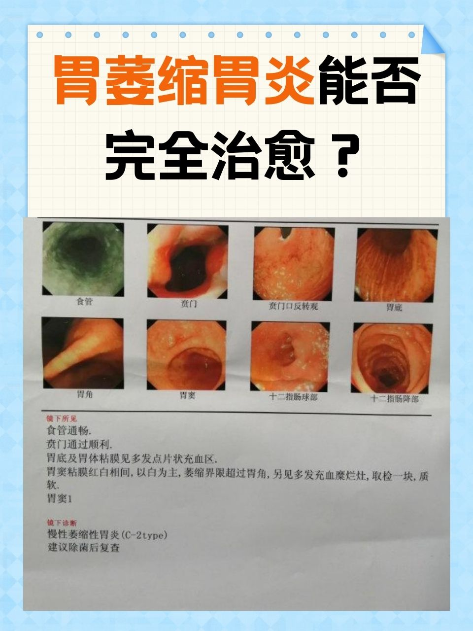 糜烂性胃炎怎么冶?