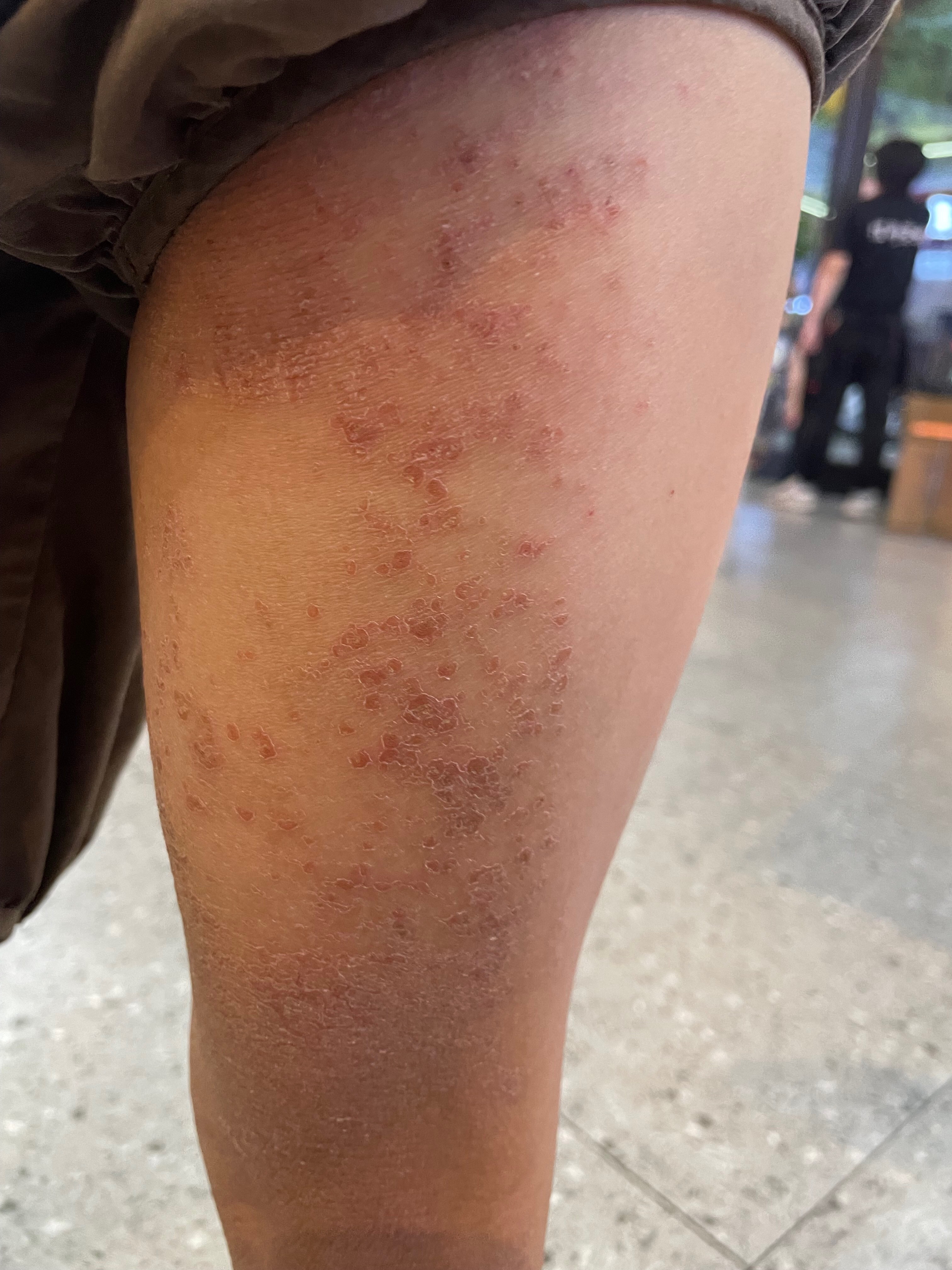 冬天全身痒是什么病