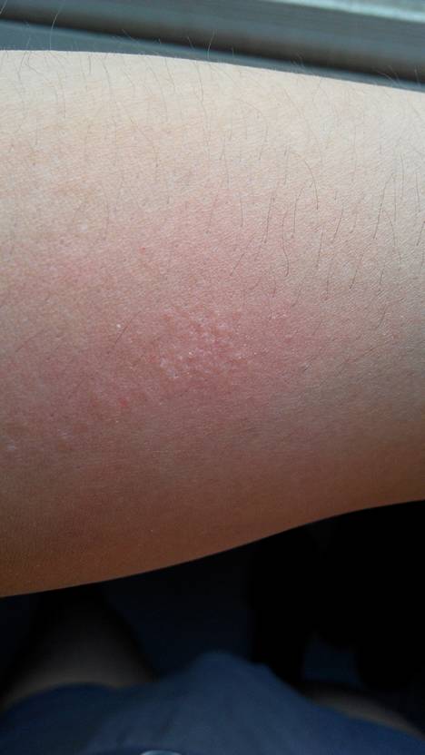 胳膊肘上起很多小疙瘩硬且瘙痒