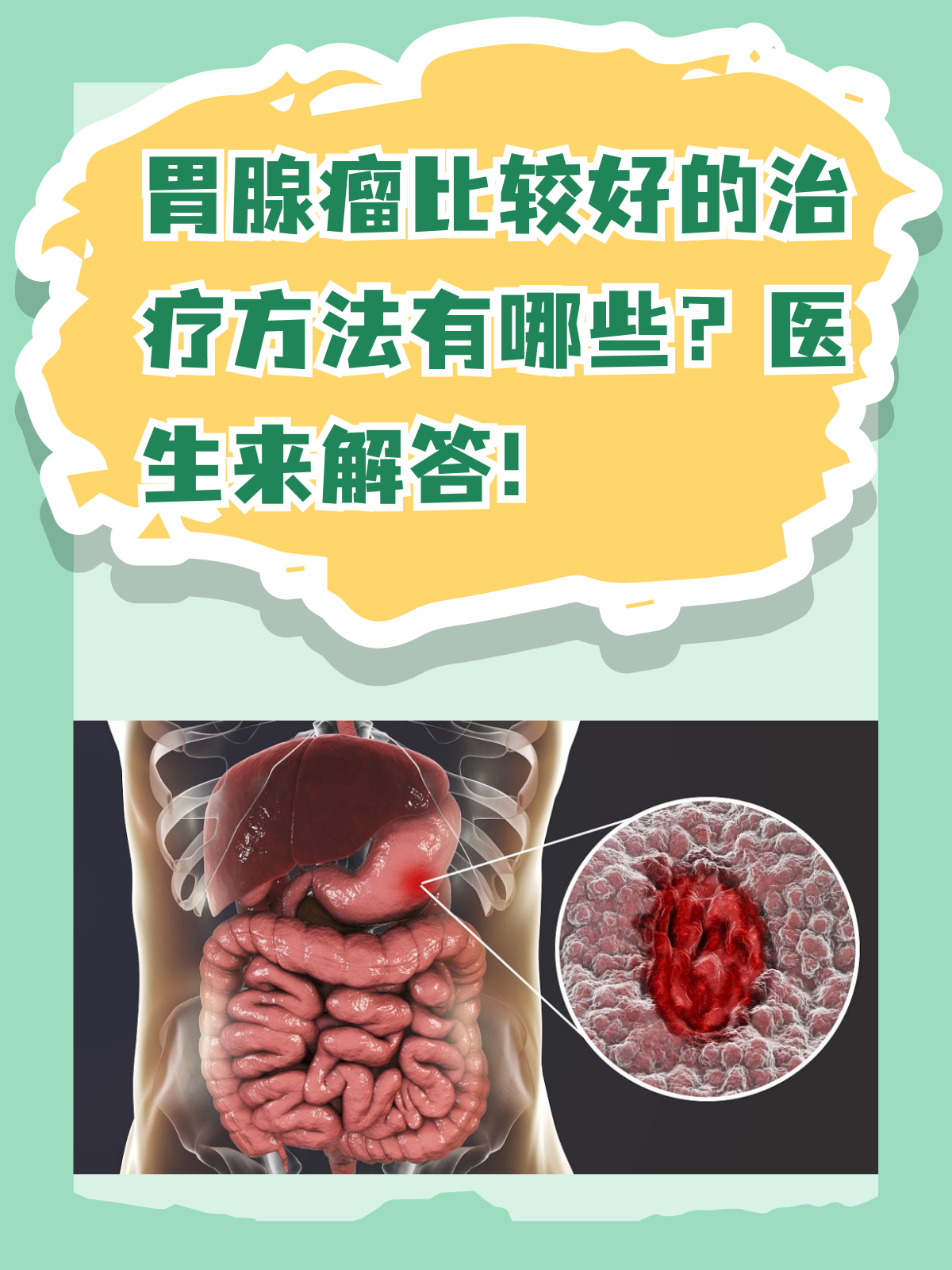 胃肠疾病的种类有哪些
