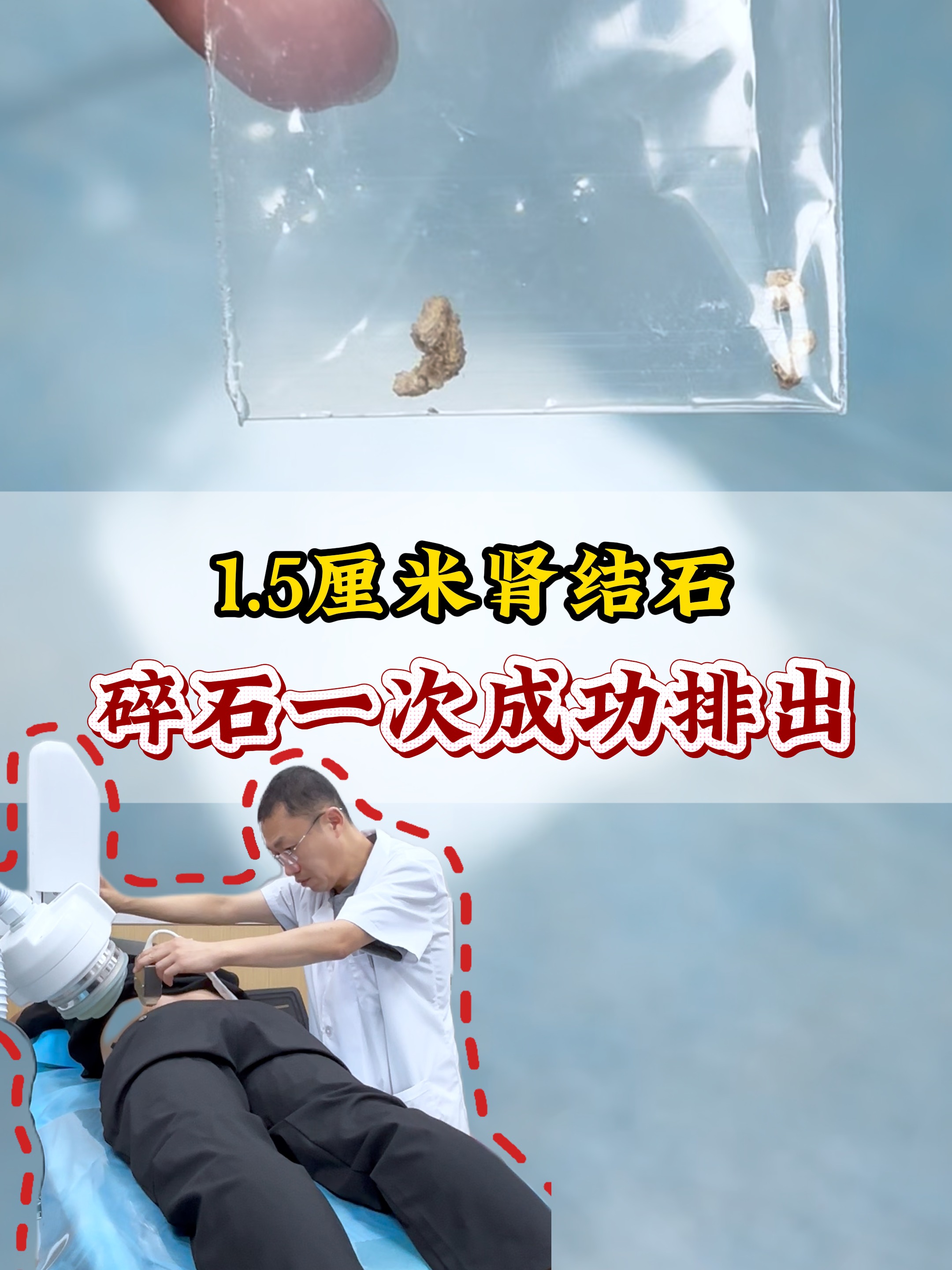 肾结石体外碎石能全排出吗?