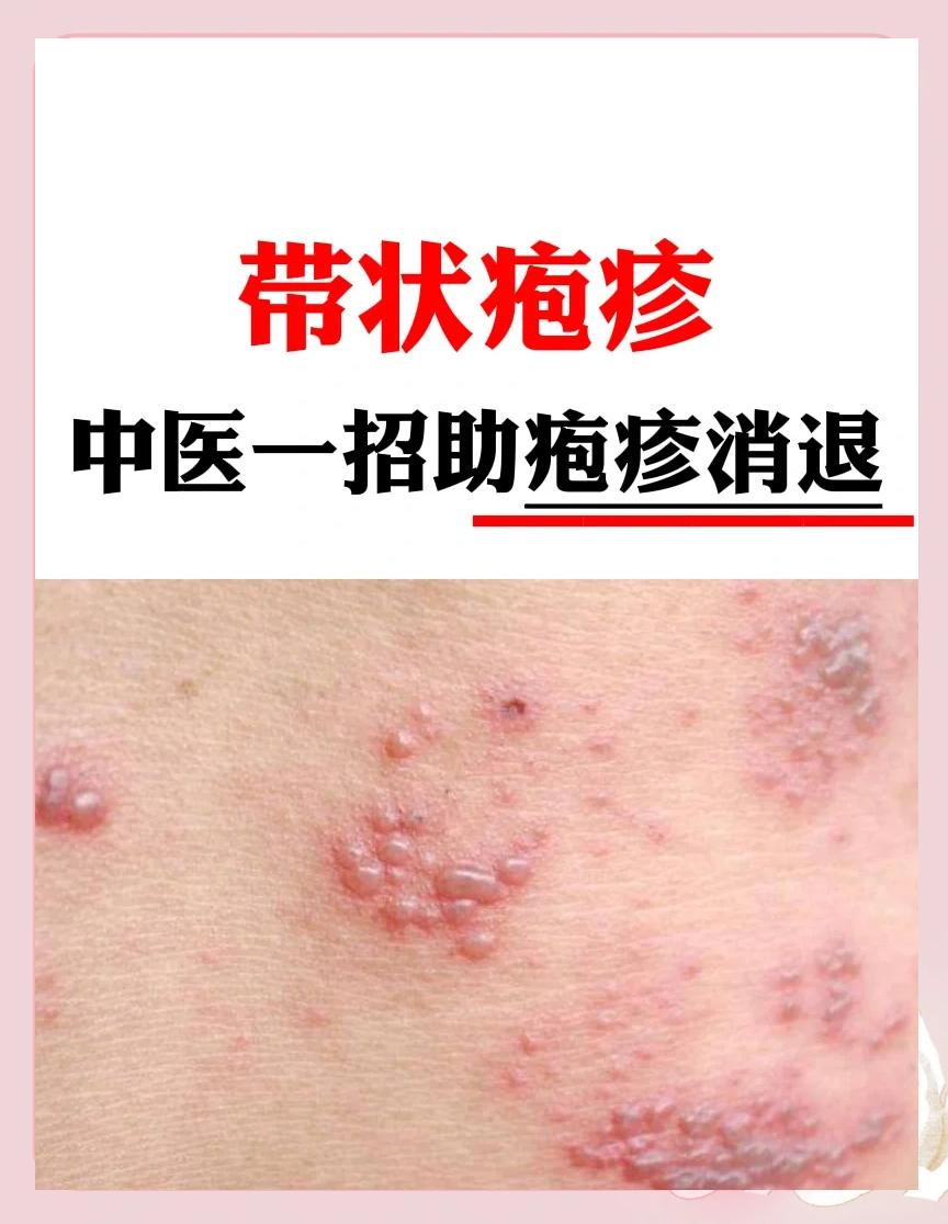 带状疱疹怎么治疗?