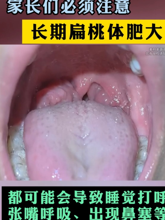 孩子扁桃体肥大会自愈吗