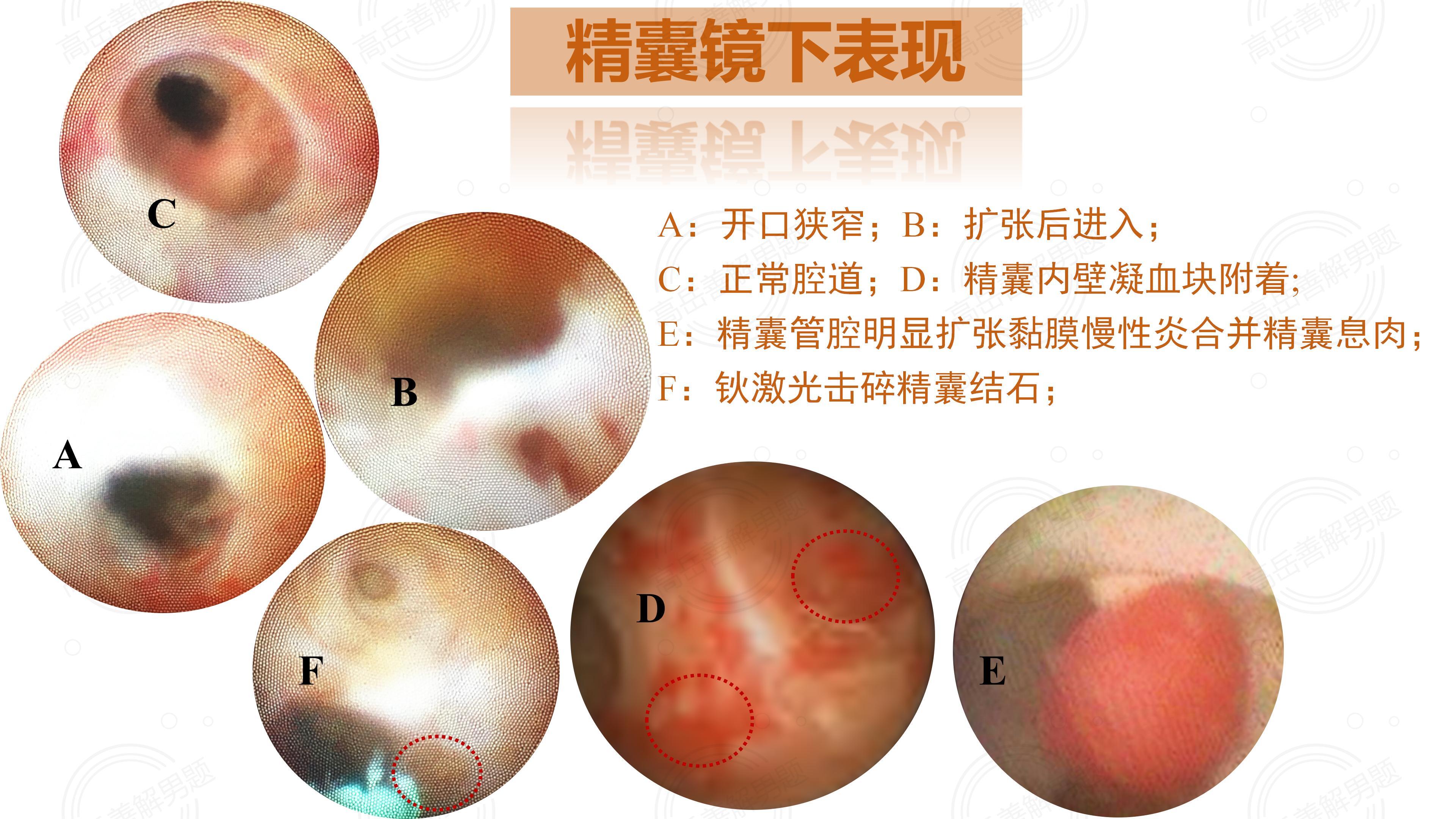 精子成活率低怎么治疗
