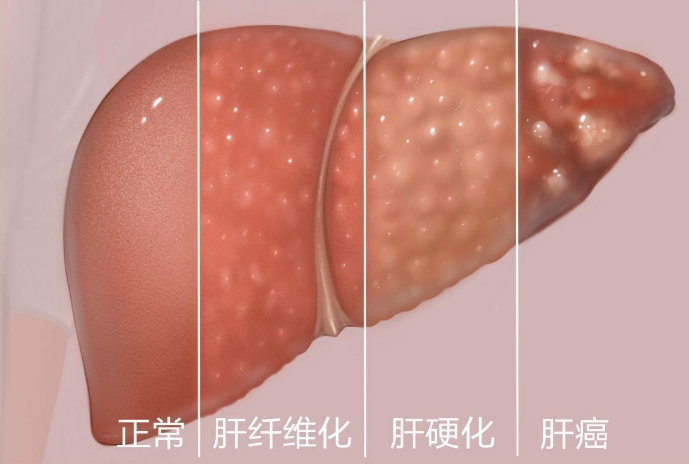肝纤维化是什么意思