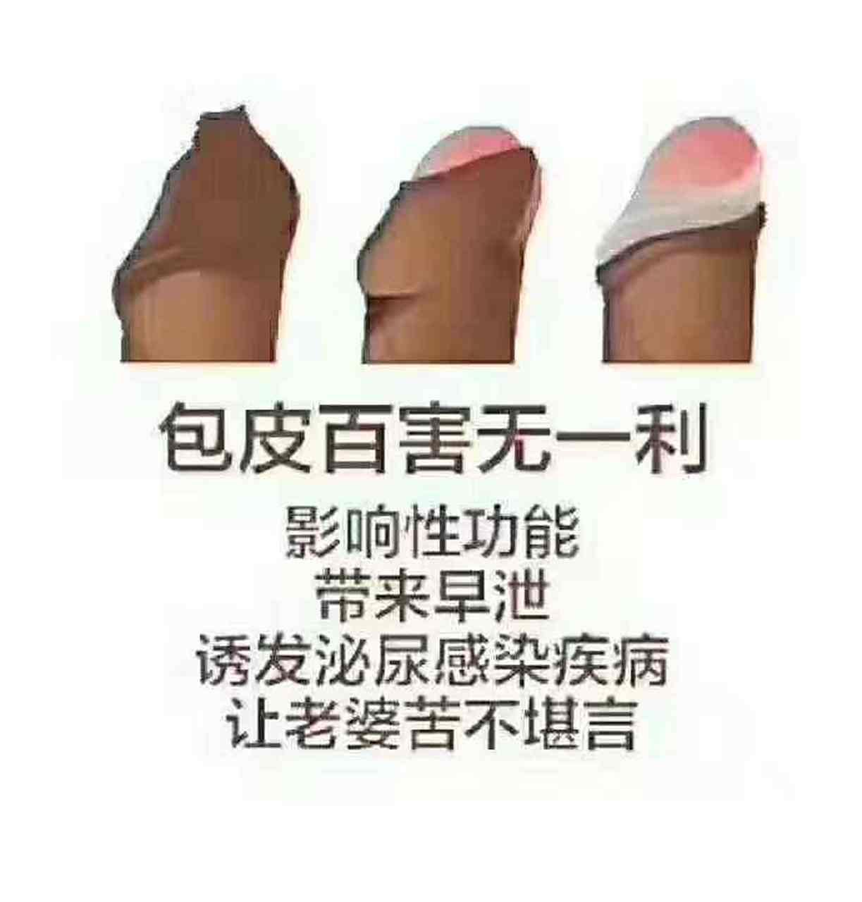 假性包皮过长