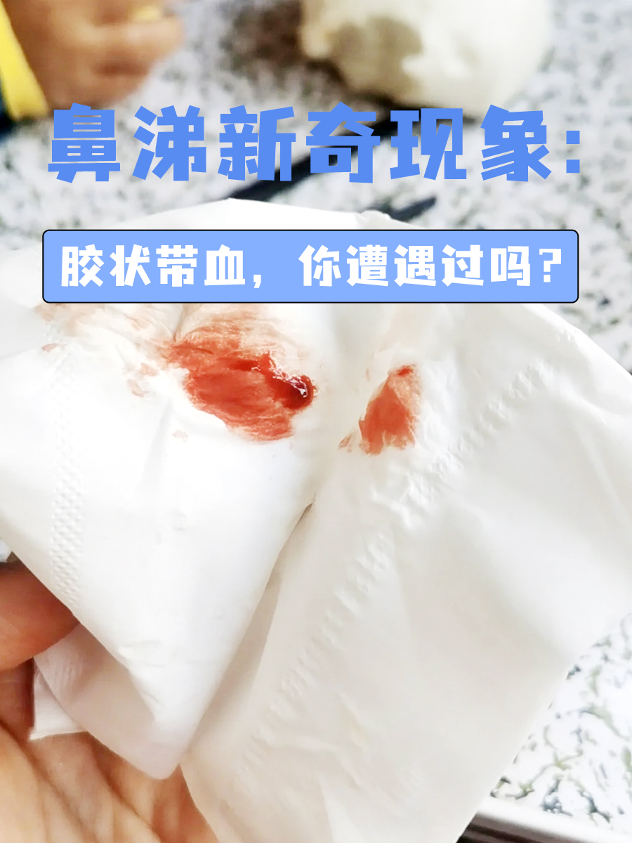 擤鼻涕带血是什么原因