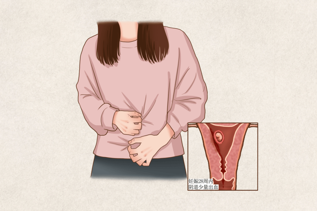阴道出血原因有哪些?