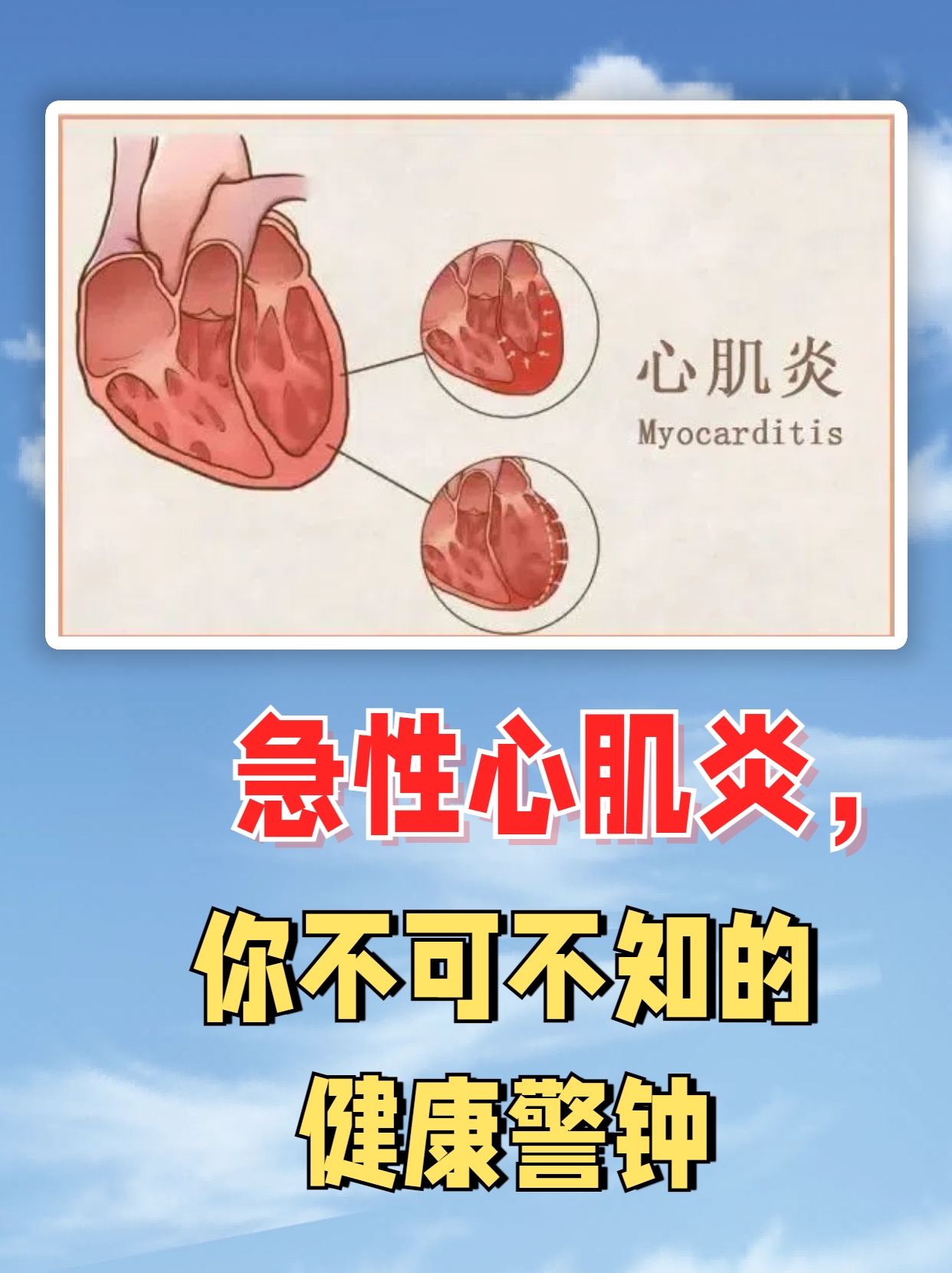 病毒性心肌炎症状有哪些?
