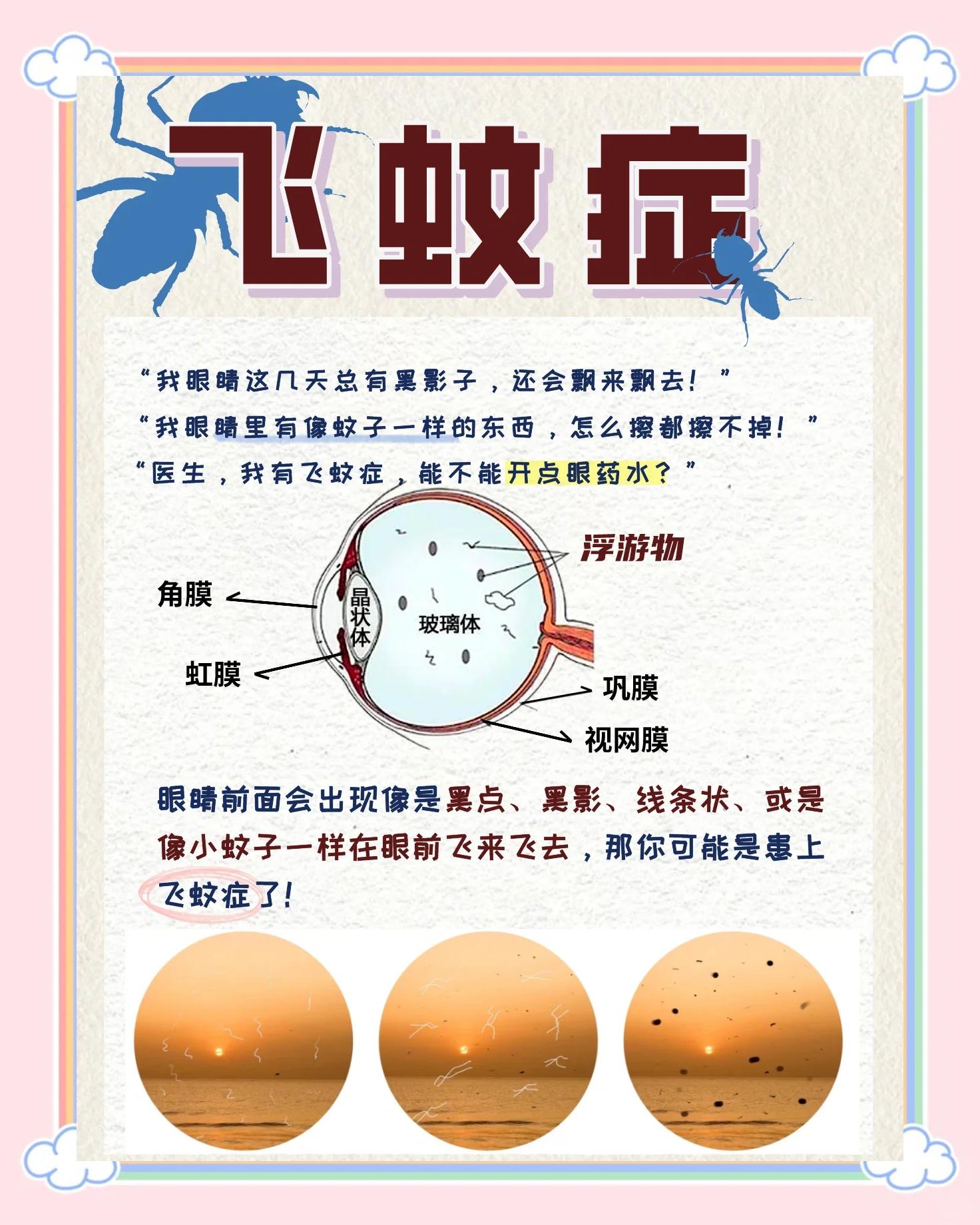 眼睛飞蚊症是什么原因