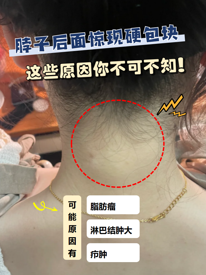 脂肪瘤怎么形成的????