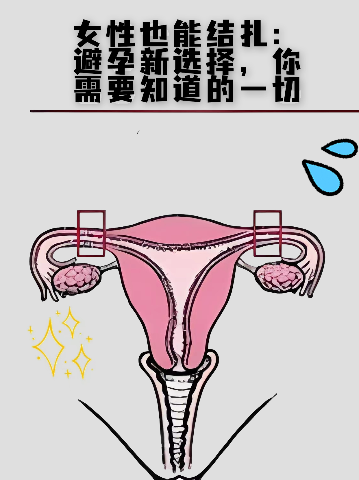 女性结扎需要开刀吗