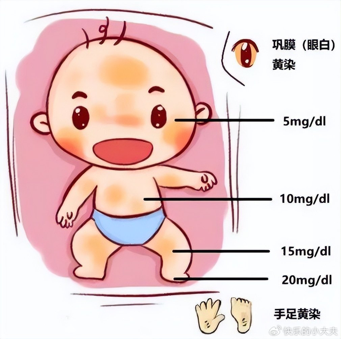 孕妇吃橘子胎儿会黄疸吗
