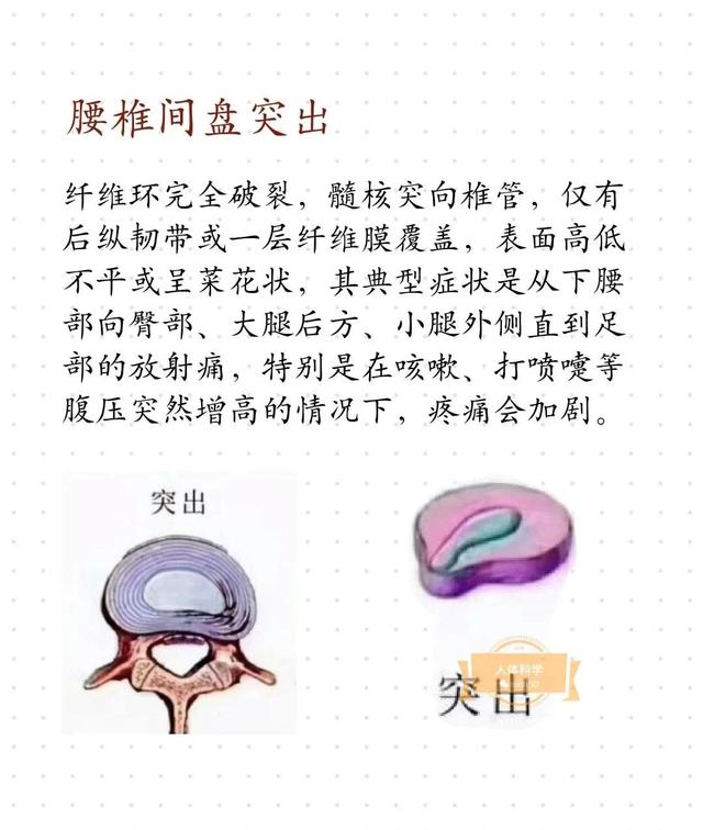 腰椎间盘轻度膨出要紧吗?