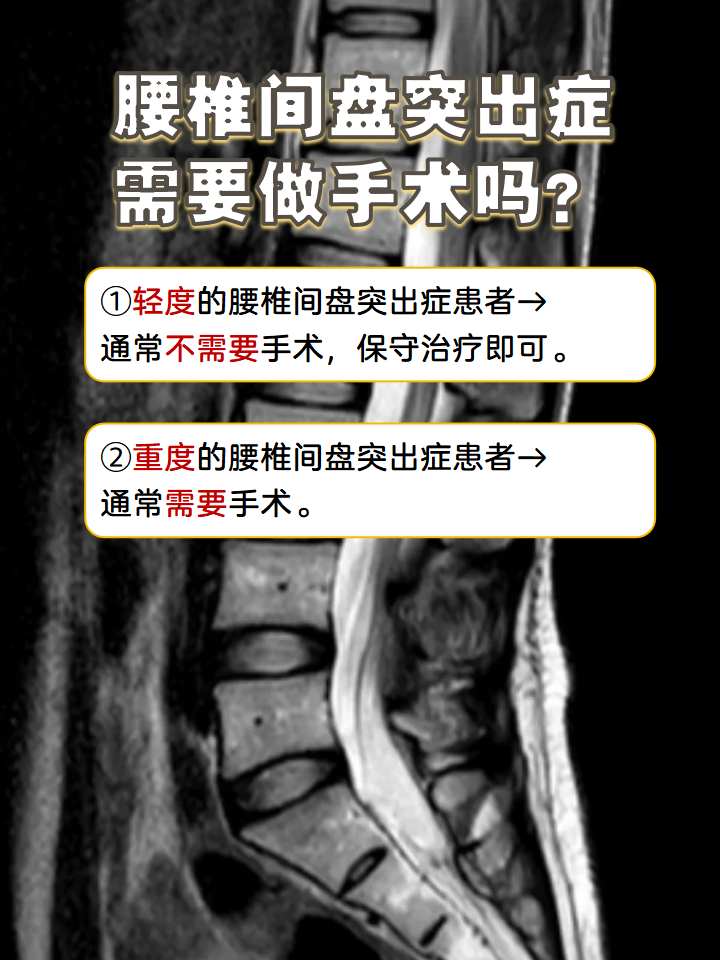 腰椎间盘轻度膨出要紧吗?