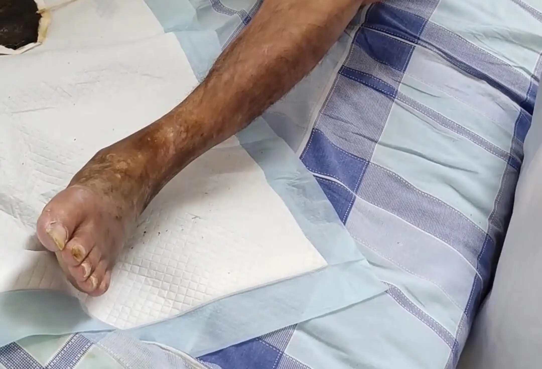 骨髓炎严重吗