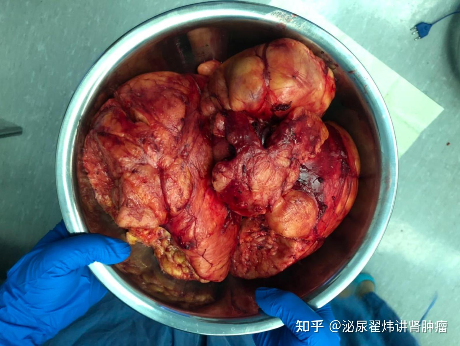 什么是肾错构瘤?