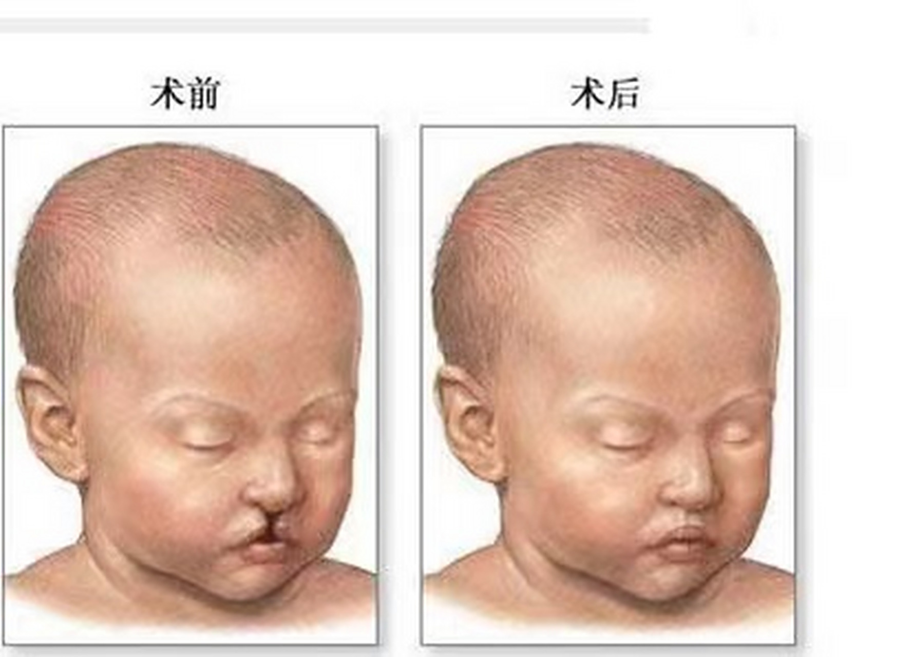 兔唇真的会遗传吗