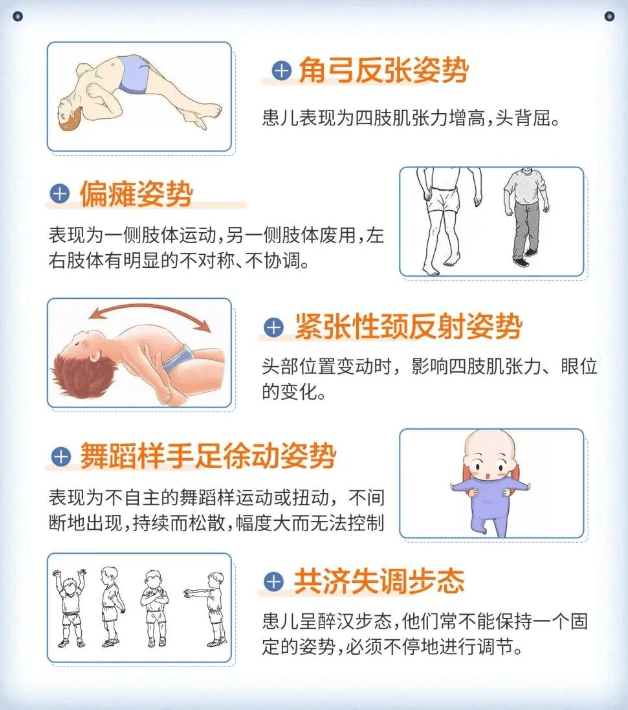 婴儿脑瘫的早期症状有几种