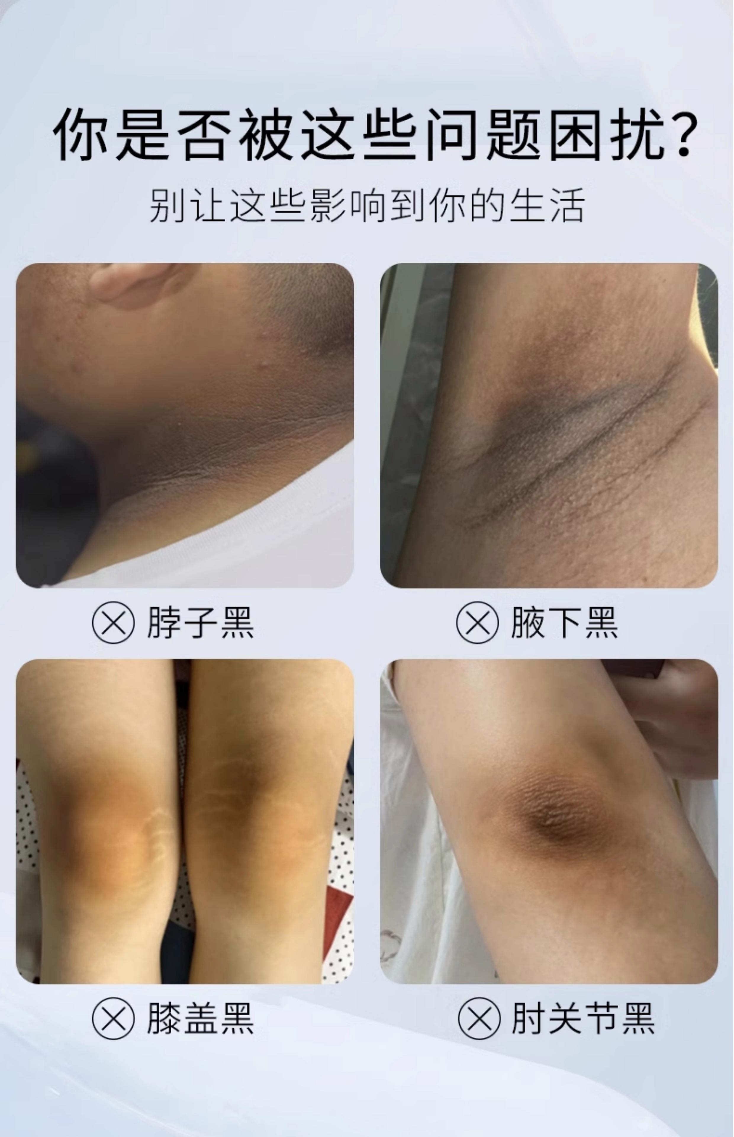 晒伤后如何快速美白