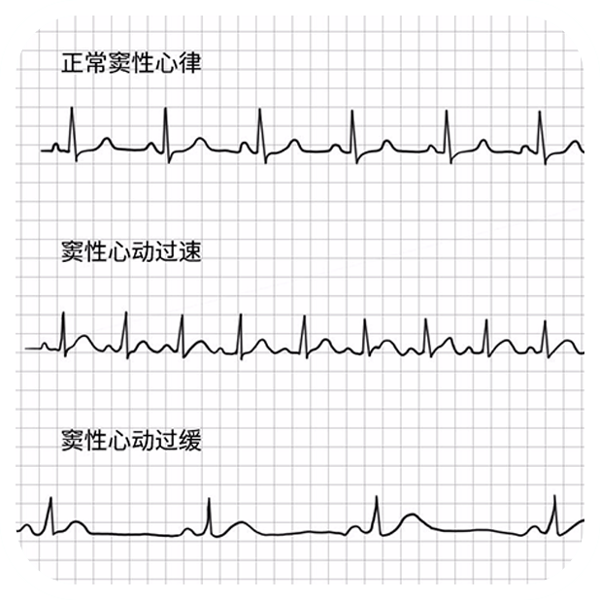 窦性心动过缓的常见病因