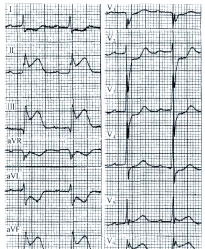心电图ST段抬高是怎么回事