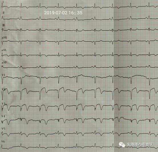 心电图ST段抬高是怎么回事