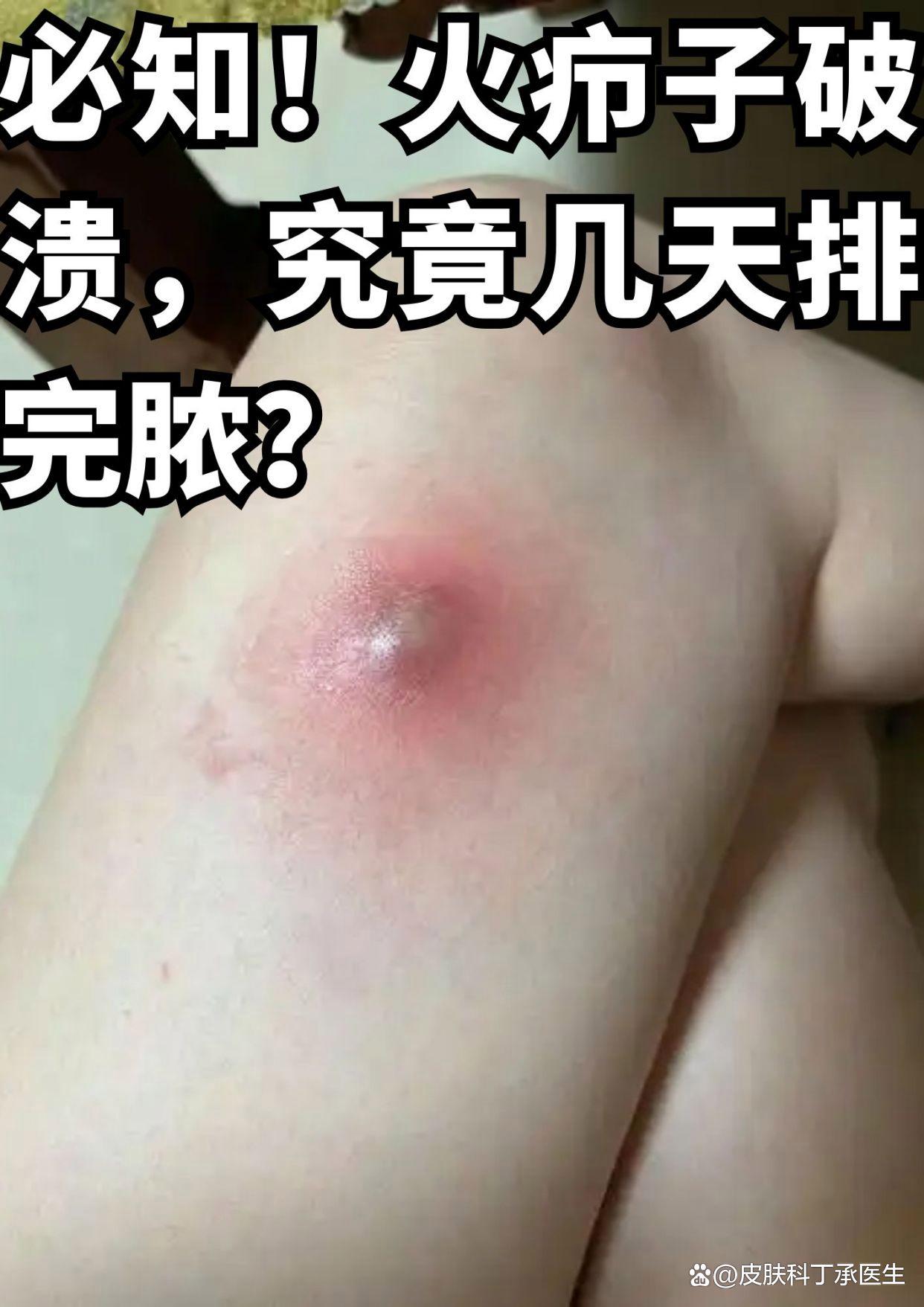 疖子怎么治