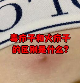 毒疖子和疖子区别从疾病的症状表现就可以区分