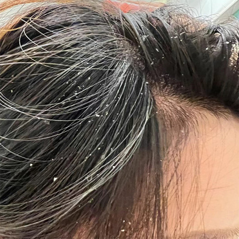 头皮脂溢性皮炎症状