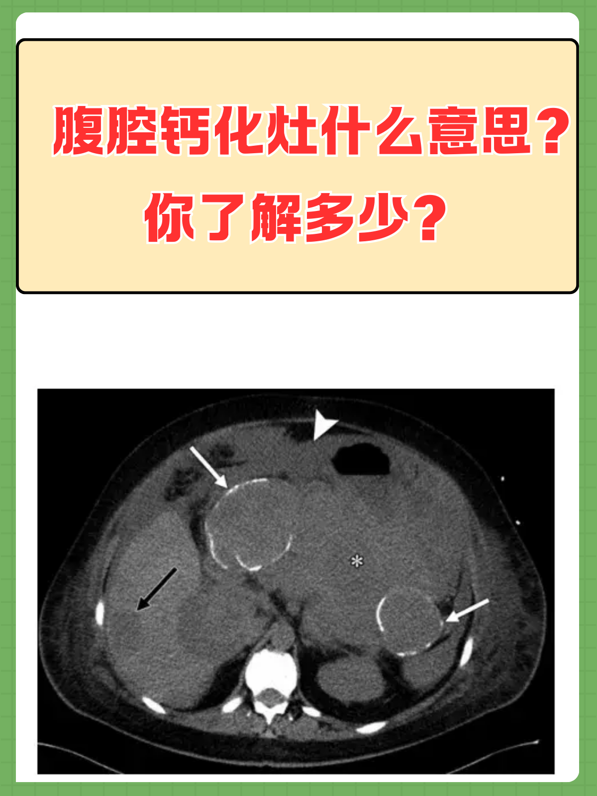 肝内有钙化是什么意思
