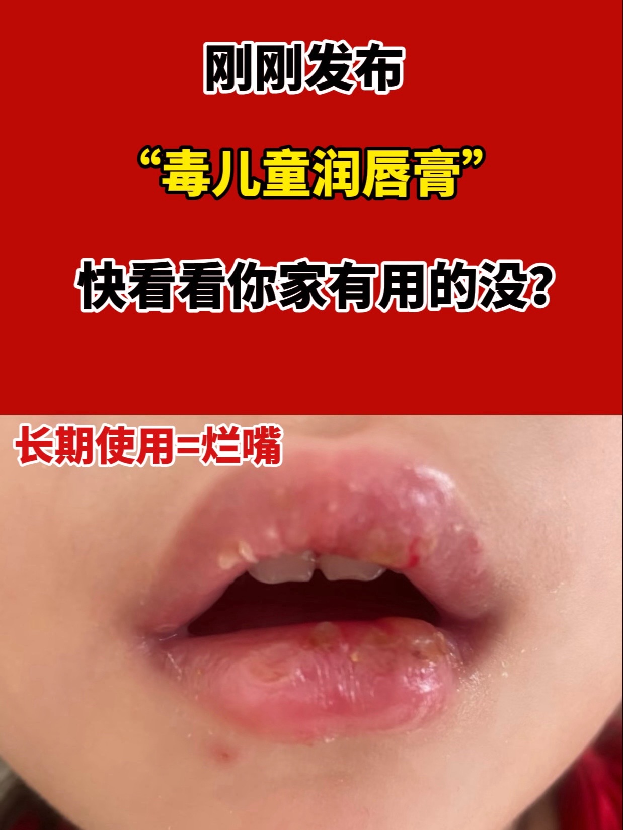 新生儿嘴唇发紫怎么回事