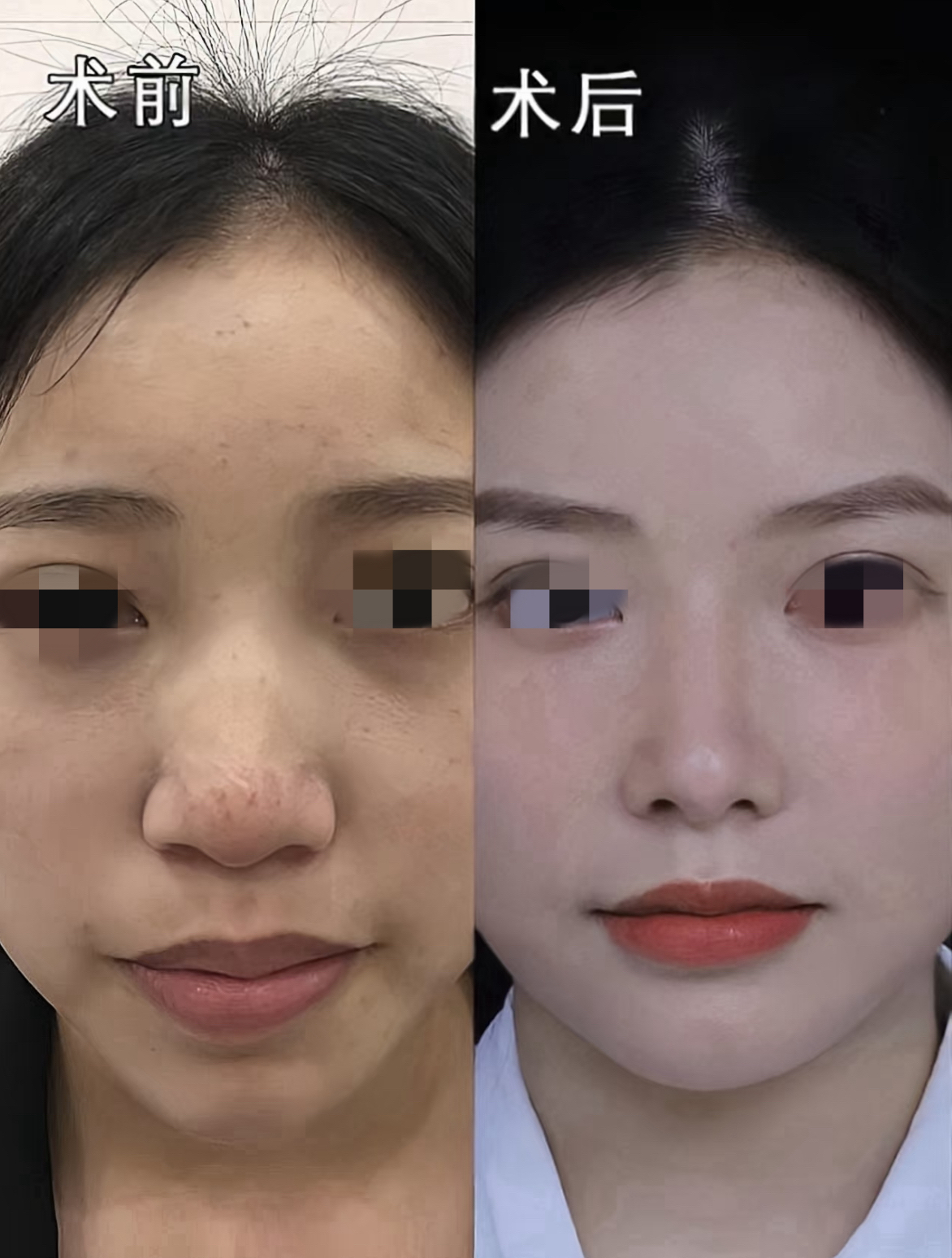 鼻子塌了怎么办