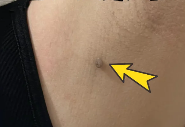 腋窝里面长了个小疙瘩