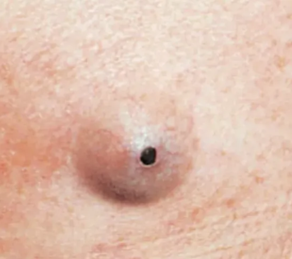 腋窝里面长了个小疙瘩