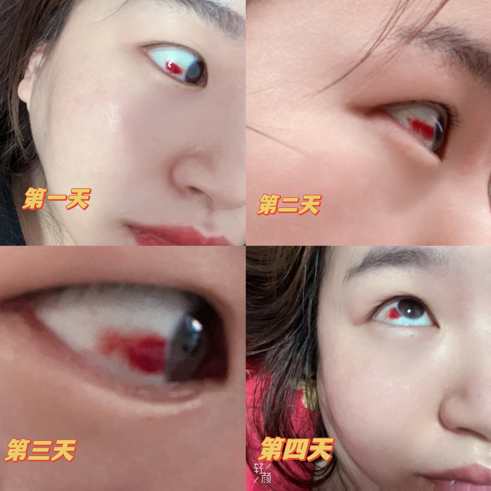 眼睛里有一块血块怎么消除