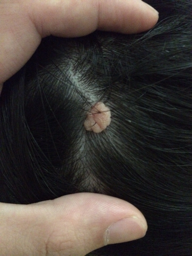 头皮上长了一个肉疙瘩