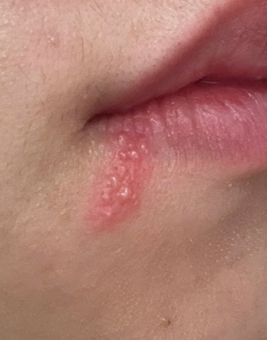 嘴巴疱疹是什么病